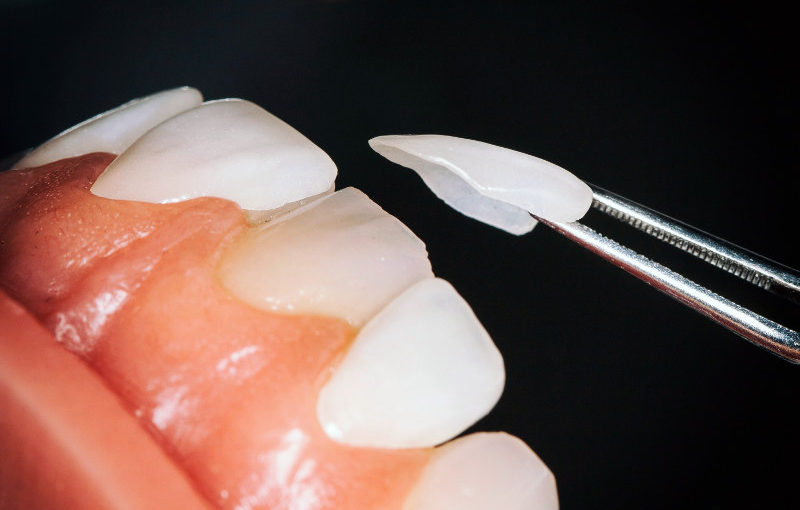 carillas de porcelana en Lleida opcion dental carillas de porcelana en Lleida opcion dental