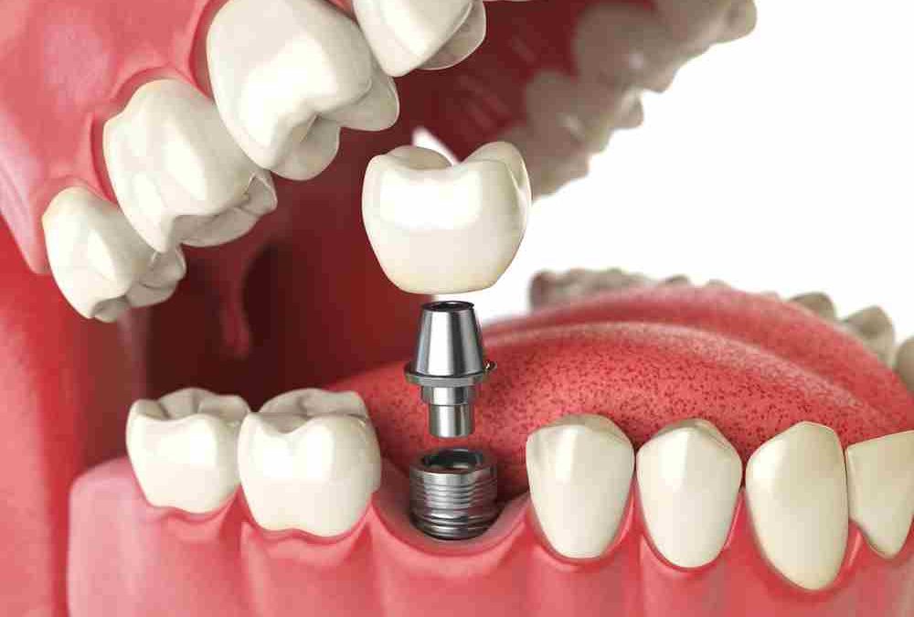 implantes dentales en Lleida