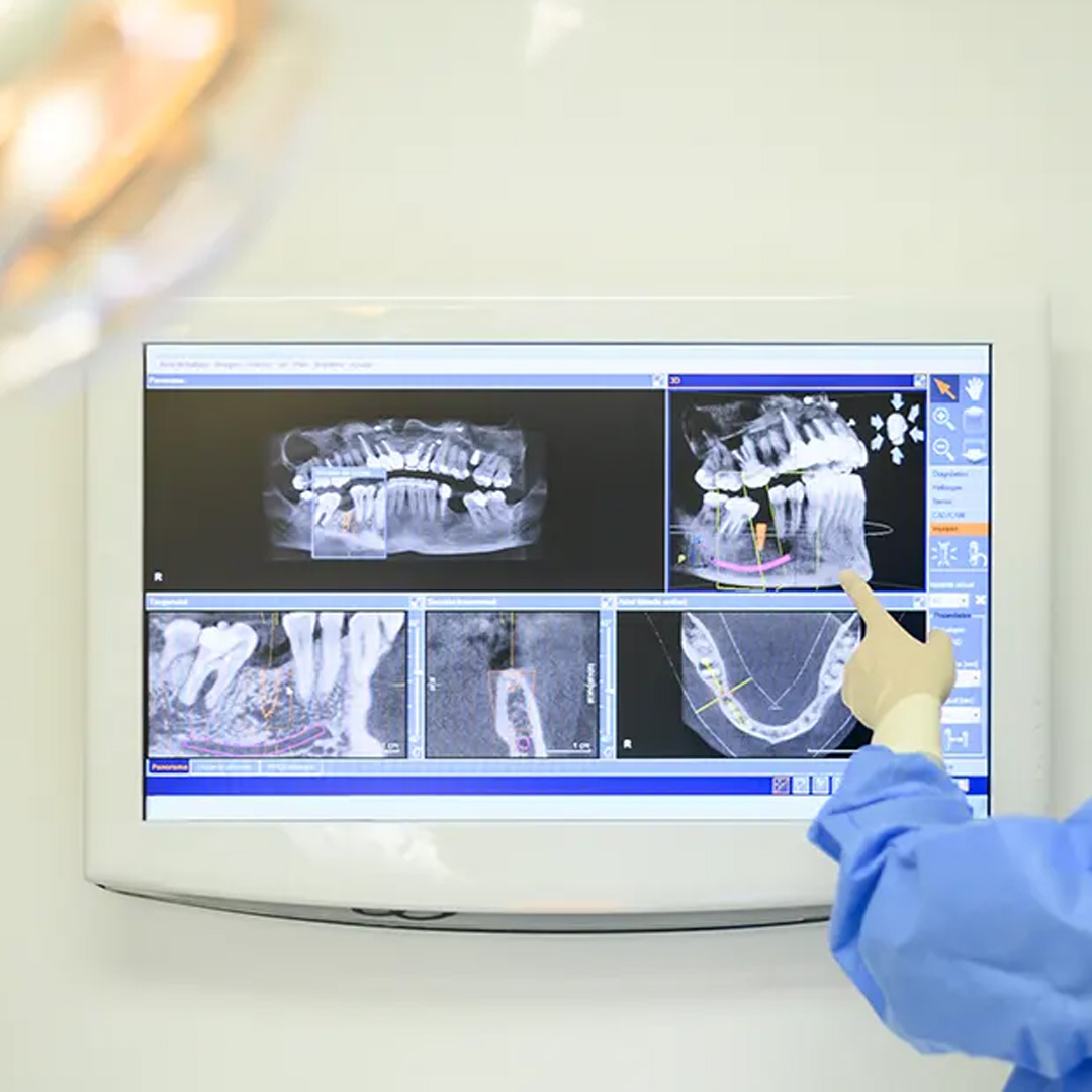 implantes dentales en lleida con cirurgia guiada por ordenador