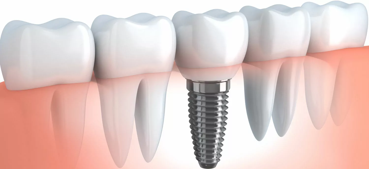 tratamientos con prótesis dentales en Lleida Clínica Opción Dental