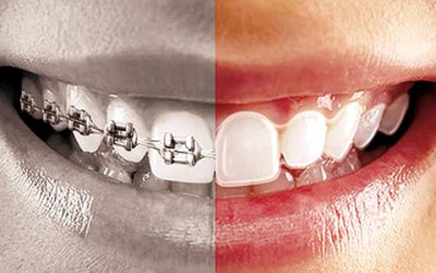 Mitos y verdades de la ortodoncia